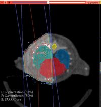Example CT scan showing tissue definition prior to dose-volume analysis